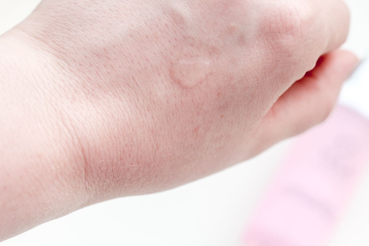 The Tula Acne Clearing Gel shown on the skin.