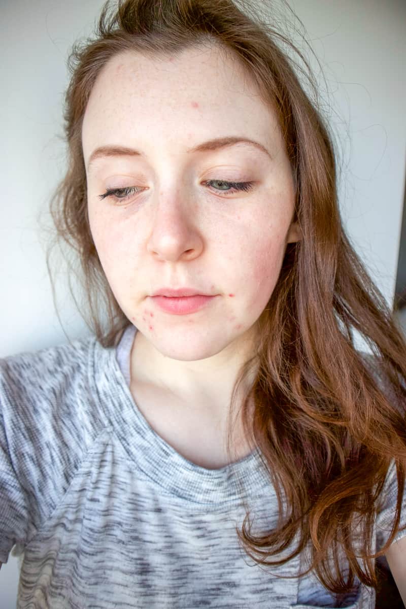 Before using the murad acne cleanser.